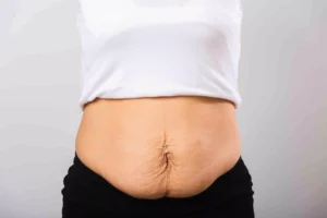 Diastasis Recti (Mummy Tummy)