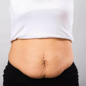 Diastasis Recti (Mummy Tummy)